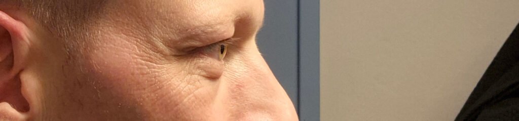 Augenliderkorrektor seitlich vorher Augenliderkorrektor von der Seite vor der OP